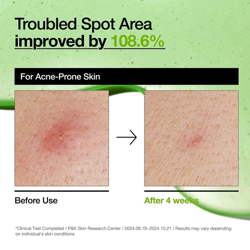 Azelaic Acid 10 Hyaluron Redness Soothing Serum - 30ml