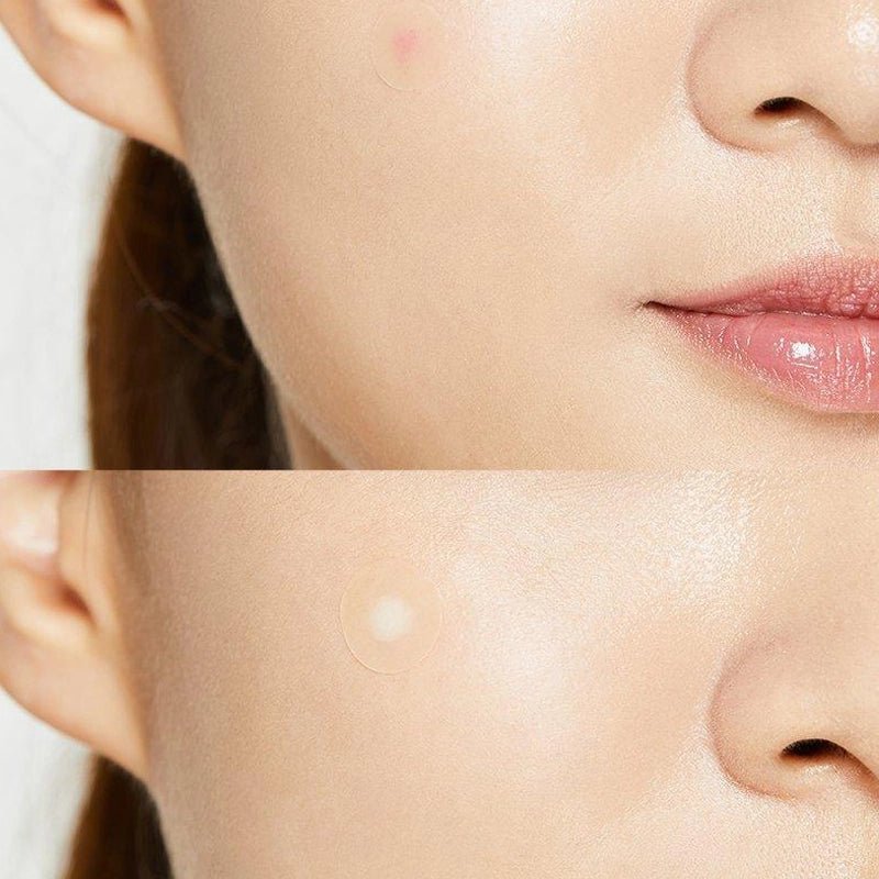 Acne Pimple Master Patches - 24pcs